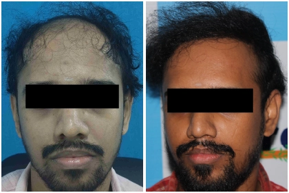 Hair Transplant Treatment